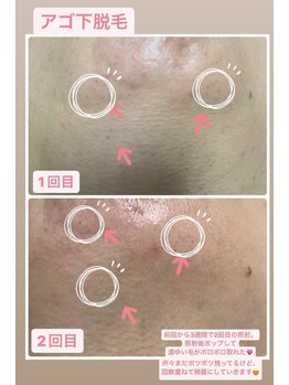 ルアナ(Luana)/女性も気になる!あご下脱毛