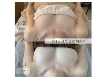 デミーナ(Demyna)/【バストアップ】症例 育乳