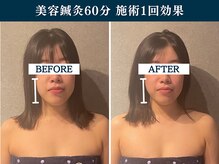 シンク(CINQ)/中顔面小顔矯正/美容鍼灸60分