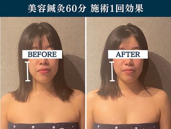 シンク(CINQ)/中顔面小顔矯正/美容鍼灸60分