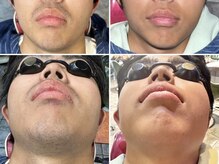 リノ(Lino)/髭脱毛