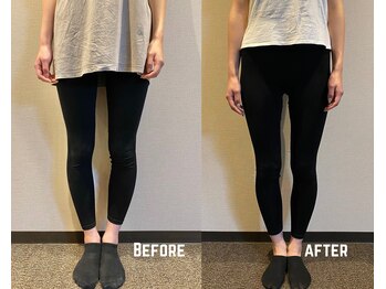 タイコ接骨院 栄本店/【O脚改善BeforeAfter】