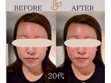 チョコバリ 新宿店(chocobari)/小顔×リフトアップ(美容鍼)20代