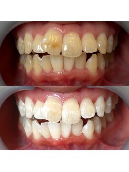 ワールドビューティー(World Beauty)/プレミアムホワイトニング6回