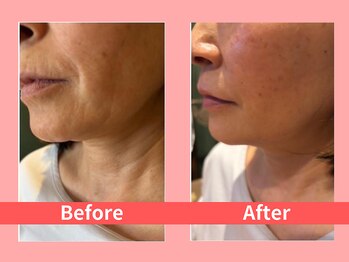 オーダーメイド痩身&小顔矯正専門店Re:Lives【リライブ】金町店/レッドショット小顔美肌