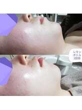 RiとBiのたまご/（フェイシャル）レモンボトル