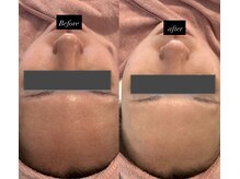 アミティエ 恵比寿駅前店(Amitie)/【施術症例】毛穴洗浄×顔脱毛