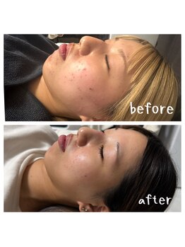 ミシカ 横浜(Mythica)/ 最新の針入りハーブピーリング