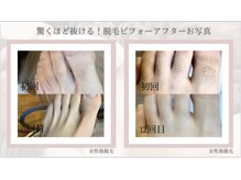 フォフォ 仙台泉店(Fofo)/光美肌脱毛機械