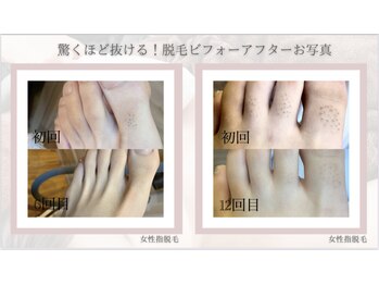 フォフォ 仙台泉店(Fofo)/光美肌脱毛機械