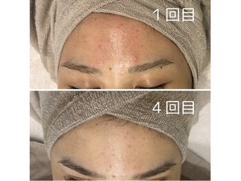 モンド 駒込店(monde)/ハーブピーリング