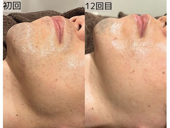 ロワ(Roi)/【肌荒れ改善×顔脱毛】12回施術
