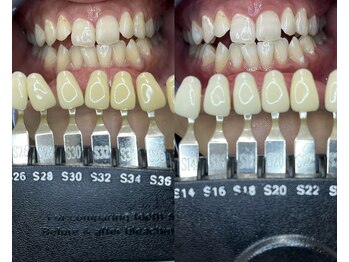 トウキョースワーズ 渋谷店(TOKYO SWRS)/#ホワイトニング #渋谷 #池袋