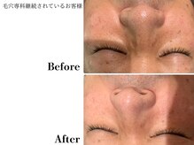 フレイヤ(FREYA)/毛穴専科Before→After