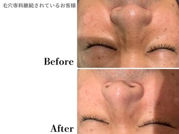 フレイヤ(FREYA)/毛穴専科Before→After