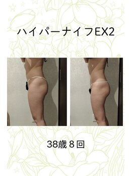 ベルシア 吉祥寺店(BELCIA)/ハイパーナイフEX2/ダイエット