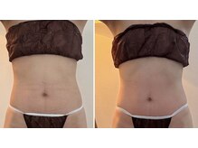 サロンドプレマージュ(Salon de Premage)/腸もみ/ビフォーアフター