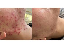 セルヴィノバ(CELL VI NOVA)の雰囲気（ニキビケア満足度◎！！これまでの自分から卒業する根本改善！）