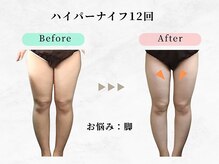 美容整体ウェリナ 中川八田院/【ダイエットbefore→after】