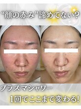 ウニカ(Unica)/顔の赤み/ゆらぎ肌