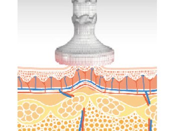 エステドルース(esthe de Ruth.)/セルライトゼロ２