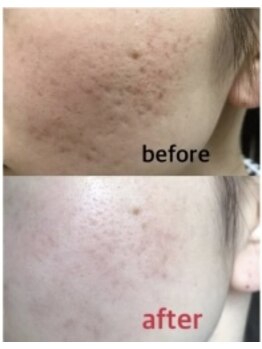 リヒト(LiHiTO)/ハーブピーリング★剥離あり