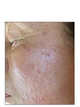 ノーブル 新宿南口(NOBLE)/ハーブピーリング専門新宿