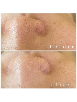 メナードフェイシャルサロン 岐阜茜部/毛穴ケア/くすみ/透明感/美白