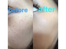 クリニカルホワイトケア(クリニカルWHITEケア)/シミケア