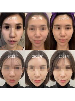 ラ クレール ビューティーサロン(LA CLAIR)/小顔リフト2018年～2023年経過