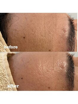 リリー(Lily)/フェイスワックス1パーツ