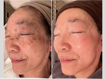 5つ星/◆ハイドロ毛穴洗浄