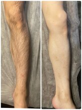 オーロラ(Aurora)/全身脱毛1回目→2回目