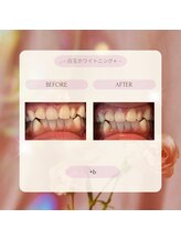 プラスビーセルフ(+b self)/ホワイトニングビフォーアフター