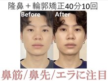 ラプリ 梅田店(Raplit)/隆鼻＋輪郭矯正40分10回