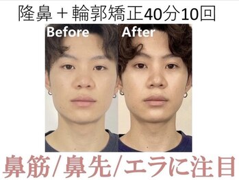 ラプリ 梅田店(Raplit)/隆鼻＋輪郭矯正40分10回