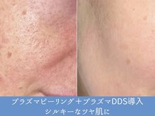 シュリー(Sriii)の雰囲気（プラズマはピーリング・殺菌・毛穴引き締め・美容液の浸透効果◎）