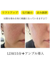 プリュボーテ(Pul Beaute)/LDM導入しました！