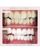 エクシアホワイトニング 札幌中島公園店/Before After［ホワイトニング］