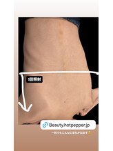 モアトゥインクル 福山神辺店(MORE twinkle)/背中脱毛