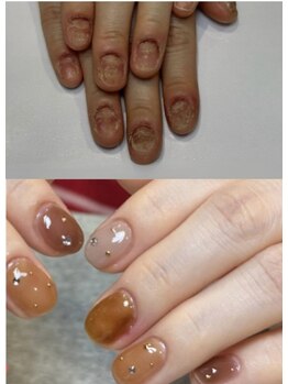 ティアラネイル 宇都宮/深爪矯正