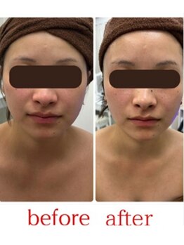 ステラ(Stella)/小顔施術