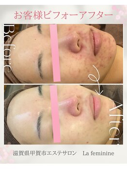 ラ フェミニン(La feminine)/20代モニター様☆毛穴ニキビ改善