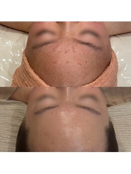 ジャストミービューティー(Just Me Beauty)/肌質改善/毛穴ケア/ニキビケア