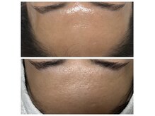 ルル(Ruru)の雰囲気（ラミピール＋光フォトBefore→After）