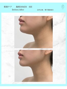 ノット(KNOT)の写真/【枚方唯一/施術後ケア】吸引・ダウンタイム後のお悩みに◎自身の体験×身体分析で早期の完成をサポート♪