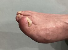 爪のいろは/こうなる前にケア始めましょう♪