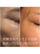 太陽と月/炭酸ガスパックでシワ/シミ/潤い