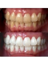 ワールドビューティー(World Beauty)/プレミアムホワイトニング6回