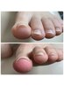 【巻き爪補正モデル10名募集】1本7500円→3500円